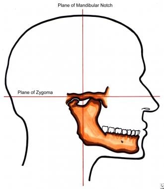 Lateral view of mandibular notch and plane of zygo