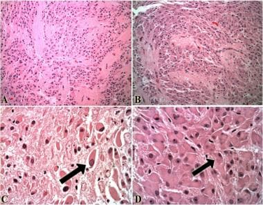H&E-stained section of a subependymal giant-cell t