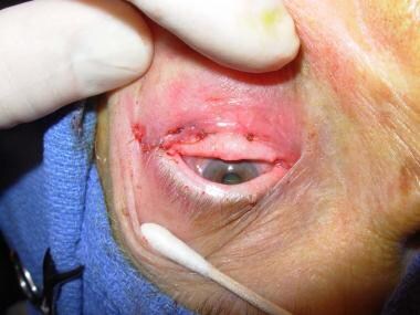 Tarsal strip has been attached laterally, and cant