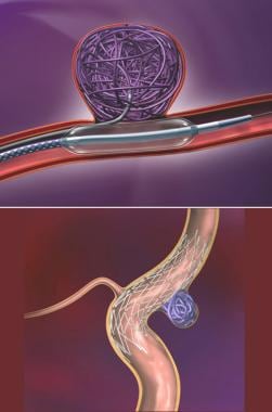 Treatment strategies for treatment of wide-necked 