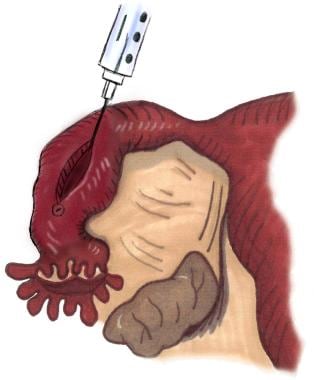 Salpingotomy technique. Linear incision is made on