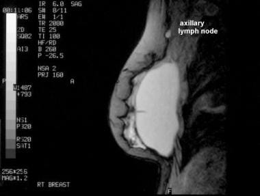 Sagittal magnetic resonance image shows extracapsu