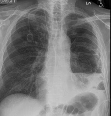 Posteroanterior chest radiograph in a patient with