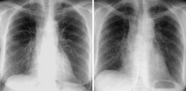 Posteroanterior chest radiograph reveals irregular