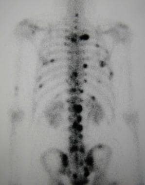 Typical scintigraphic pattern of bone metastases i