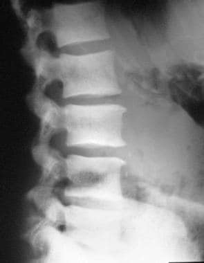 Radiograph of the dorsal spine of an adult male sh
