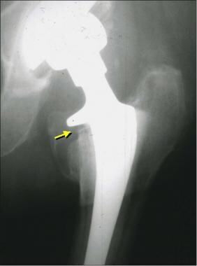 Image from an asymptomatic patient who had bone re