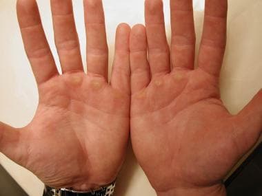 Calluses on the palmar surface of the hands of a b