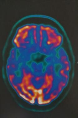FDG-PET of axial brain in 75-year-old patient with