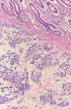 Colonic mucosa with gastrointestinal stromal tumor