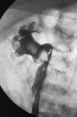 Retrograde ureteropyelogram that demonstrates a se