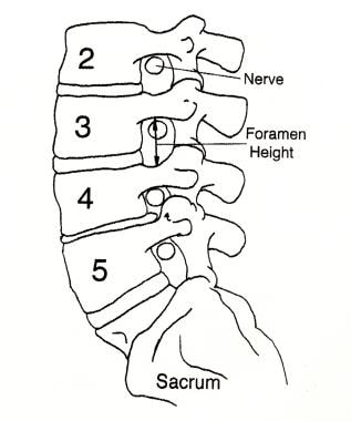 Spinal nerves exit spinal canal through foramina a