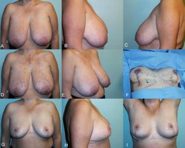 Simplified vertical breast reduction. A-E, Preoper