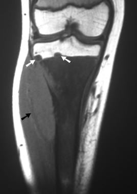 Osteosarcoma. Coronal T1-weighted MRI. Note the ab