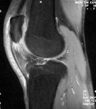 Extensor mechanism injuries of the knee. Sagittal 