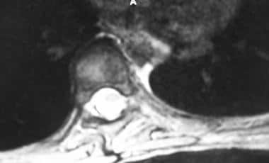 Axial MRI shows apical vertebra. 