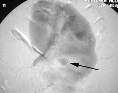 Left renal angiogram (late phase; same patient as 