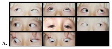 A 3-year-old patient with acquired right Brown syn