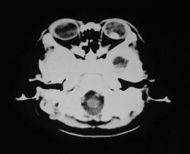 Retinoblastoma, intraocular stage (CT scan finding