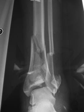 pilon fracture recovery blog