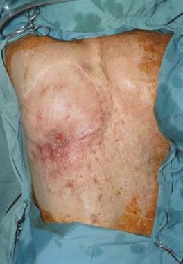 Middle-aged man with squamous cell carcinoma over