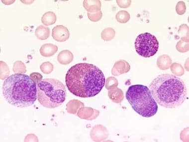 Chronic myelogenous leukemia. Blood film at 1000X 