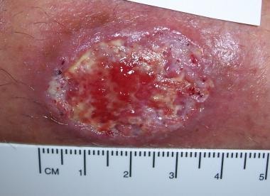Active cutaneous leishmaniasis lesion with likely 
