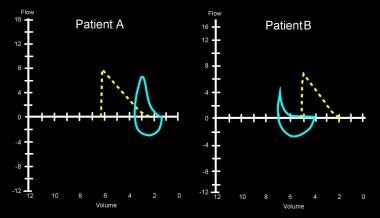 Emphysema. A flow-volume curve of lungs with emphy