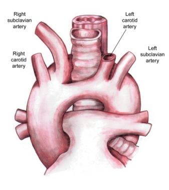 what is a double aortic arch