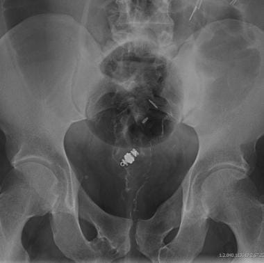 Rectal Foreign Bodies. The patient swallowed a cam