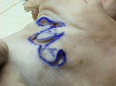 Bilobed flap procedure performed on cadaveric spec