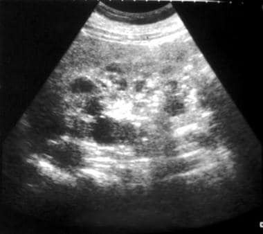 Sonogram shows cysts with bilaterally enlarged kid
