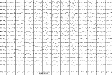 Triphasic waves in a 61-year-old man with uremia. 