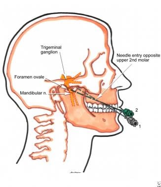 Anatomy and technique of trigeminal ganglion block
