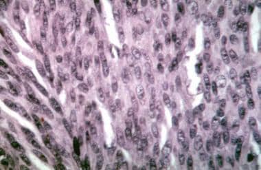 Choroidal melanoma. Histologic section showing spi