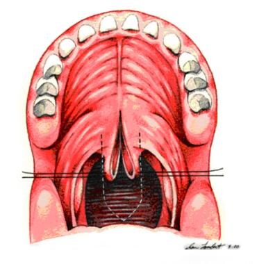 Sutures are placed bilaterally in soft palate to e