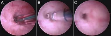 Adiana (Hologic) procedure. (A): The delivery cath