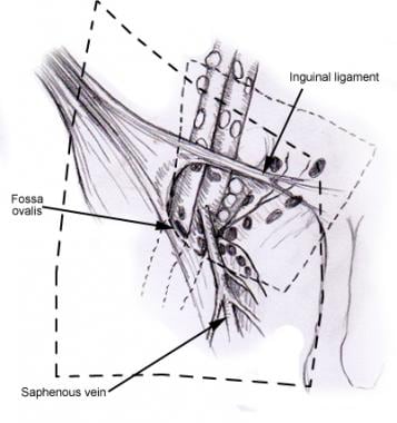 Inguinal Region Anatomy: Overview, Gross Anatomy, Pathophysiological