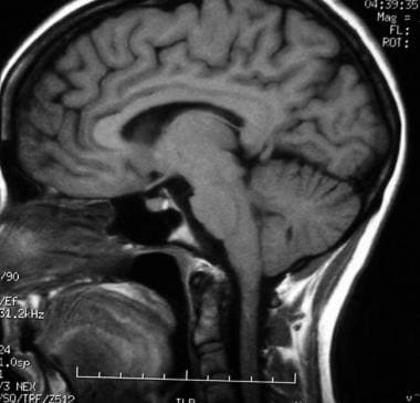 T1-weighted sagittal MRI through the pituitary fos