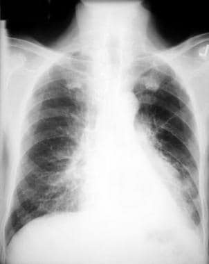 Left lower lobe collapse. This chest radiograph sh