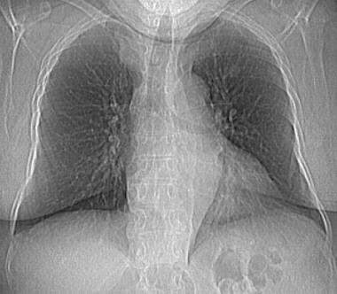 Chest radiography in a patient with laryngeal canc