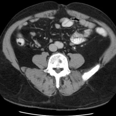 Contrast-enhanced CT image of the lower abdomen sh