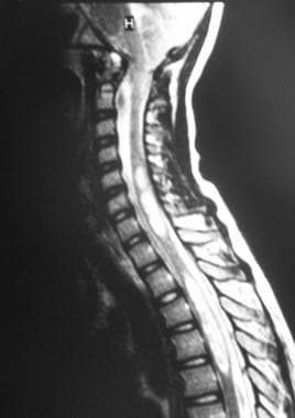 Sagittal MRI shows an Arnold-Chiari I malformation