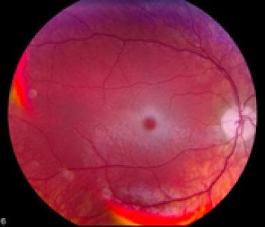 Fundus photograph showing retina changes associate