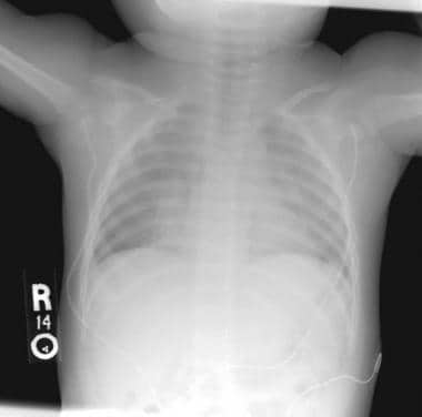 Anteroposterior view of the chest of 14-month-old 