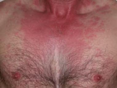 An example of a typical histamine toxicity rash, i