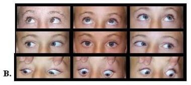 The same patient as in the image above, 6 years la