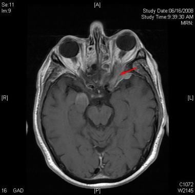 Neuroimaging study (MRI of brain and orbits) revea