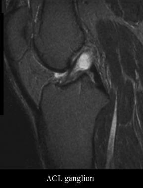 Ganglion of the anterior cruciate ligament. Courte