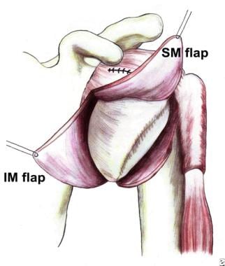 Superomedial (SM) and inferomedial (IM) flaps crea